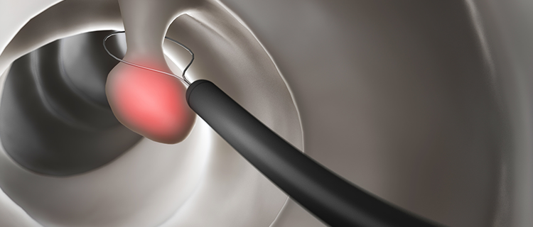 内視鏡検査に際し、鎮静剤(静脈麻酔)の使用も可能です。使用しない場合はご自身の内視鏡画像をリアルタイムに見ることもできます